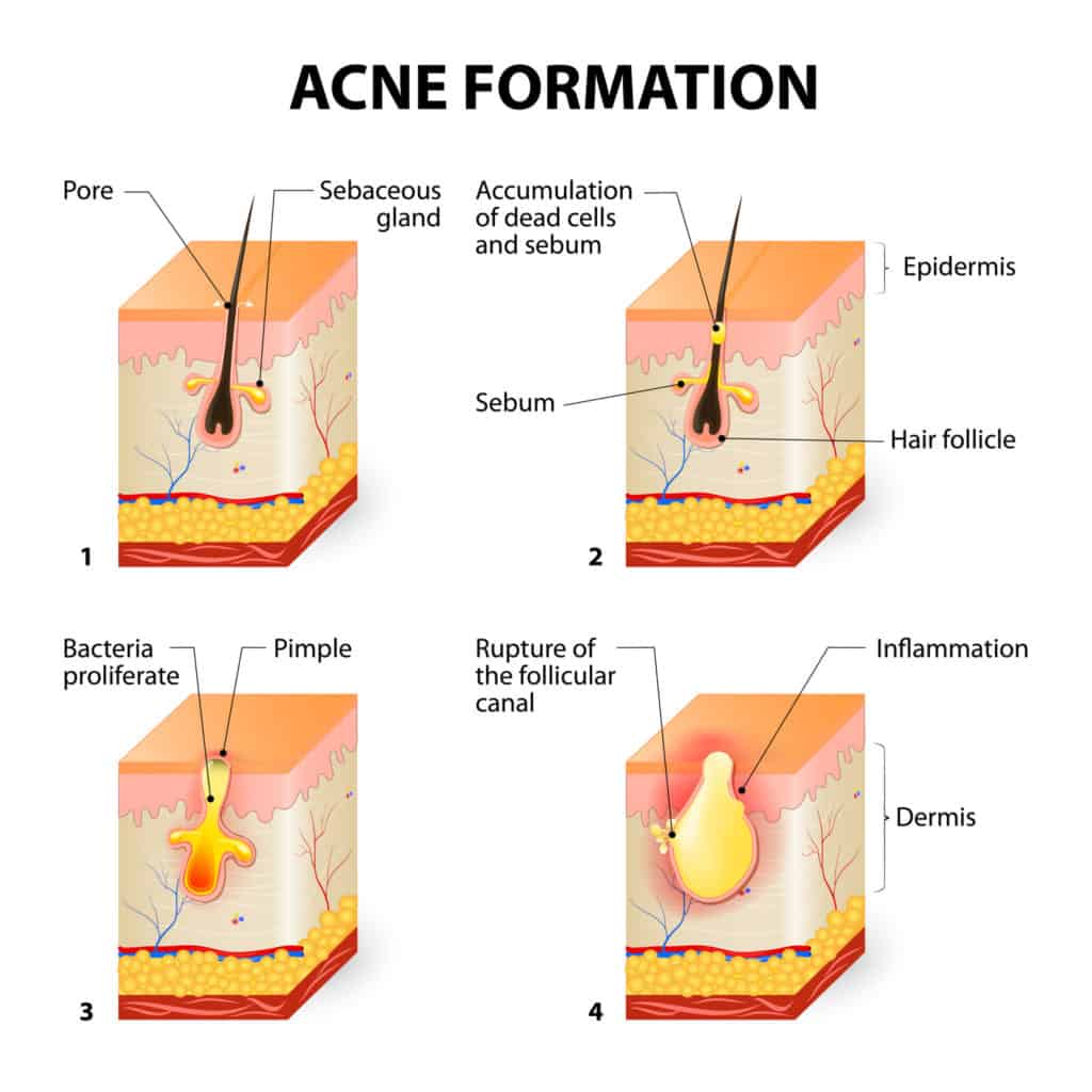 acne formation
