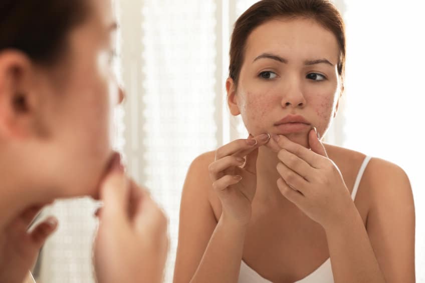acne prone skin