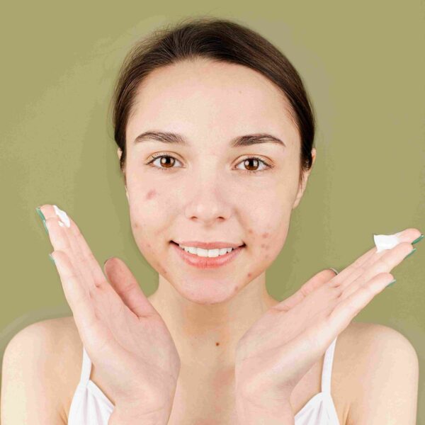 acne-prone skin
