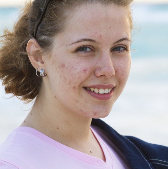 Close-up portrait of a smiling young woman with authentic acne and blemishes on her cheeks, representing acne-prone skin care on the Scenturie NZ website.